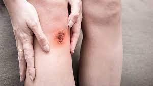 It May Be A Sore Spot Crossword Clue Wordplays Com