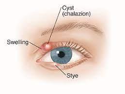Eyelid inflammation - wordplays.com