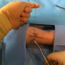 Medical stitches - wordplays.com