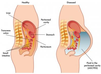 Explain Accumulation of serous fluid in the peritoneal cavity ...
