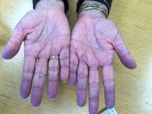 Explain A bluish-purple discoloration of skin and mucous ...